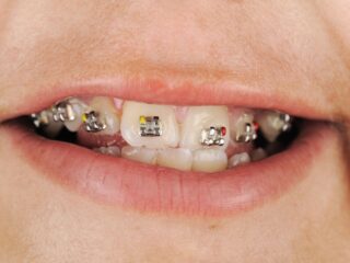 i'm getting my braces off but i still have gaps